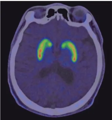 Fig. 1.  18 F-FP-CIT PET scan of Case 1. Image shows mildly decreased  18 F-FP-CIT up- up-take in the right putamen.