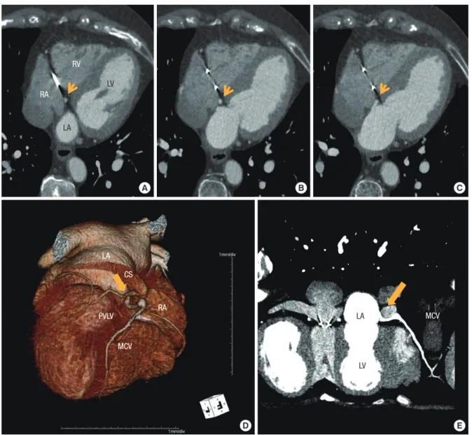 Fig. 1. Cardiac computed tomography demonstrates the middle cardiac vein draining into the left atrium (yellow arrows)