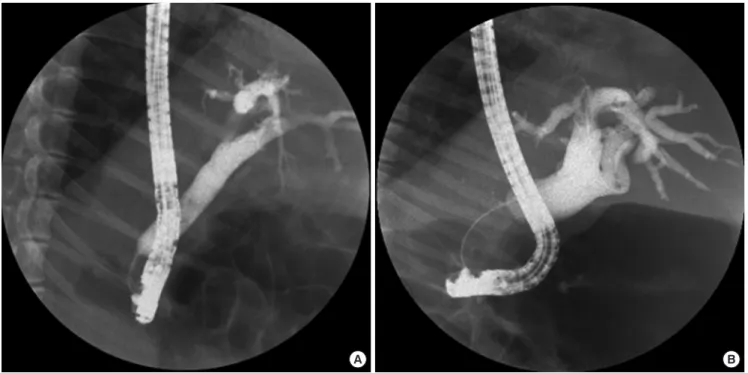 Fig. 3. Endoscopic retrograde cholangiograms after endobiliary RFA. (A) Cholangiogram at two weeks after endobiliary RFA showing stricture at site of procedure