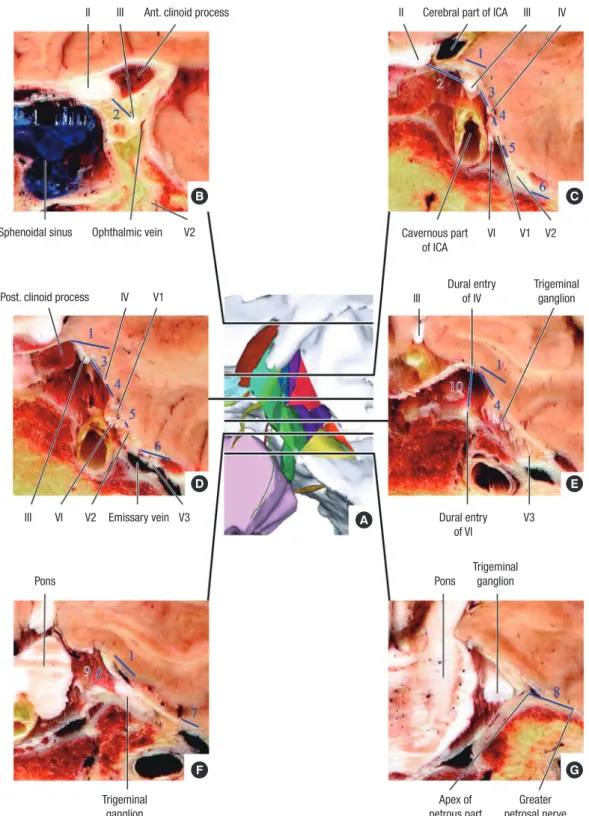 Fig. 2. Three dimensional models (A) embedding the coronal sectioned images of each triangle