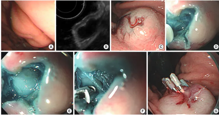 Fig. 1. Forceps biopsy technique after small submucosal dissection. (A) Endoscopic view of a gastric subepithelial tumor (SET)