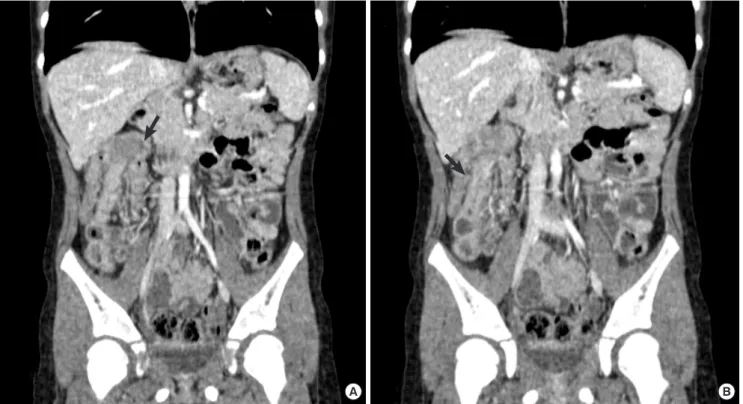 Fig. 4. Laparoscopy view showing the intussusception. Distal ileum (a) is pulled into  ascending colon (b), forming ileocolic type intussuception (arrow).