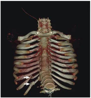 Fig. 1. Three dimensional reconstructed computed tomography showing right lower  rib fractures (arrow) and compression fracture of thoracic vertebrae.