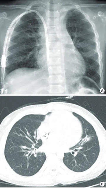 Fig. 3. Follow up imaging studies at three years post-heart-lung transplantation. (A)  Simple chest x-ray showed no active lung lesion