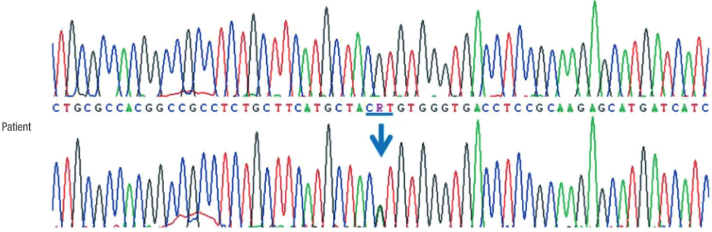 Fig. 2. Direct sequencing of the KCNJ11 gene. Partial sequences of KCNJ11 demonstrate a heterozygous mutation of c.602G>A (p.R201H).