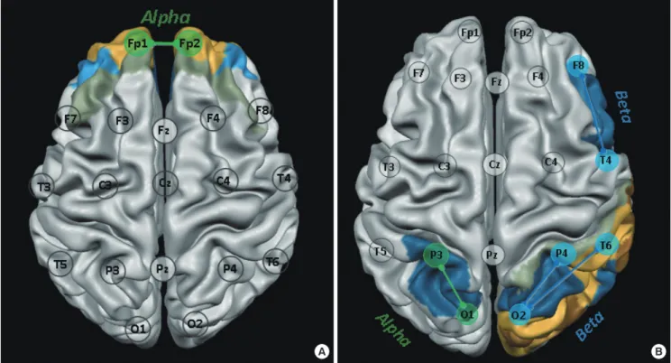 Fig. 1. Comparison of coherence between MDD+IGD and MDD-only groups. (A) Inter-hemispheric coherence