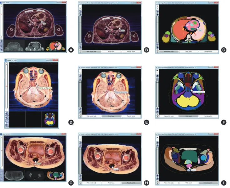 Fig. 2. Comparison of previous and new software that automatically label the names of the outlined structures of 3 cadavers