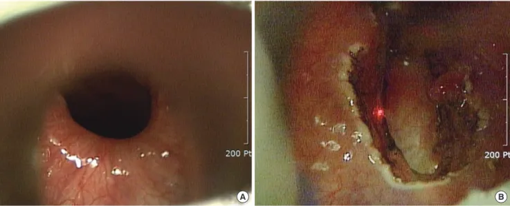 Fig. 1. Endoscopic images of cricopharyngeal myotomy. It shows visualization of the cricopharyngeus (A)