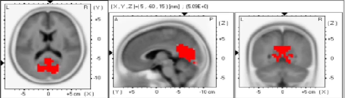 Figure  9.  Theta  wave  activation  patterns  during  CDT-2  task  vs.  CDT-10  task.