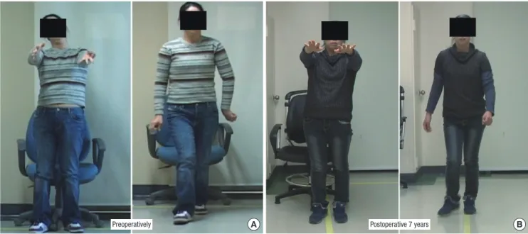 Fig. 1. Movie frames obtained from preoperative and postoperative video. (A) Movie frames obtained from a preoperative video showing the patient lifting both arms and walk- walk-ing