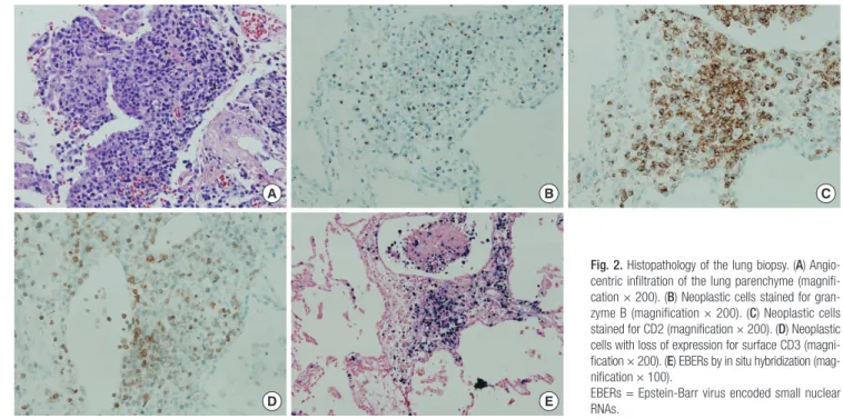 Fig. 3. PET-CT scan shows no significant FDG uptake to suggest malignancy. The lung  where ENKTCL is confirmed by biopsy also shows no FDG uptake.