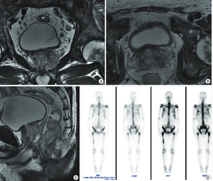 Fig. 1. Preoperative prostate MRI and bone scan images. (A) Sagittal view; (B) horizontal view; (C) axial view of MRI of the prostate showing left side-dominant PC with extra- extra-capsular extension, seminal vesicle invasion, and enlarged left external a