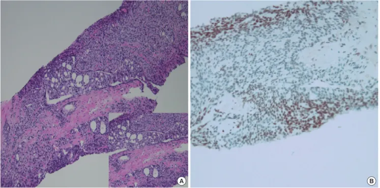 Fig. 2. Representative microphotographs of the prostate tumor. (A) Characteristic features of Gleason patterns 4 and 5, including fused glands and an almost complete loss of  glandular lumina (H &amp; E staining, [×100])