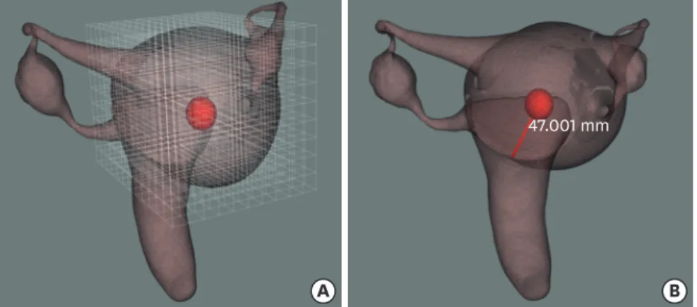 Fig. 4. 3D visualization results of a fibroid. (A) The size and distance are calculated using a grid to express the  shortest distance