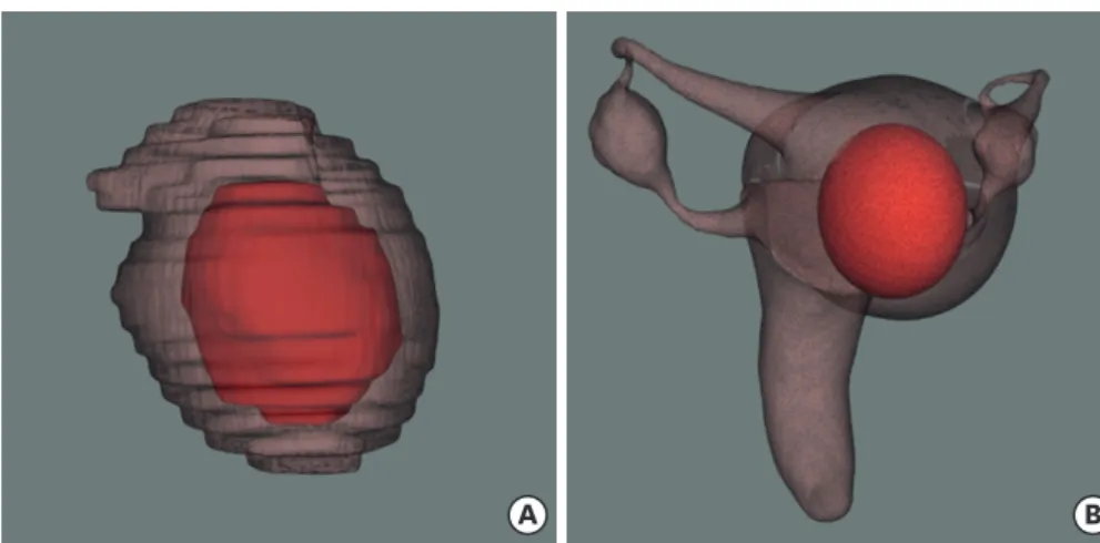 Fig. 6. Comparison of image of a uterus and a fibroid obtained by two different methods