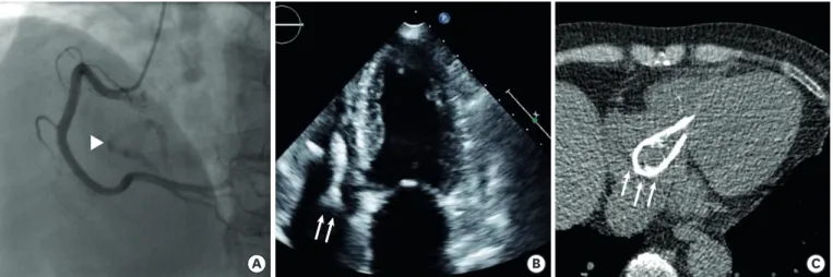 Fig. 2. The evaluation of the foreign body. (A) Fluoroscopy during coronary angiography shows radio-opaque lesion (arrowhead)