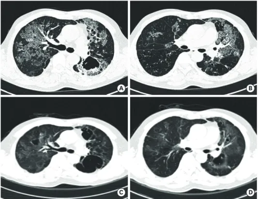 Fig. 1. Initial and 4-month follow-up images of chest CT. (A, B) Initial chest CT showed numerous clumps of tiny  nodules in are seen combined with bronchiectasis and cavitary lesions