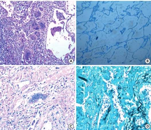 Fig. 2. Histopathological examination of the lung. (A) Hematoxylin and eosin stain (× 40)