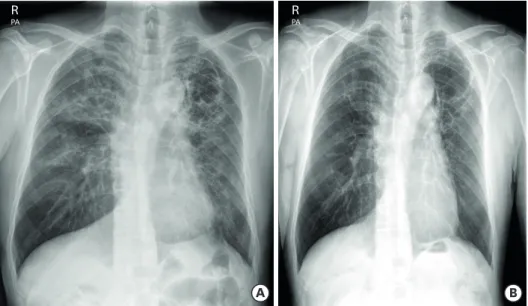 Fig. 3. Initial and 1 year after end of treatment images of CXR. (A) Initial CXR showed ground glass and reticular  opacity in the both lungs
