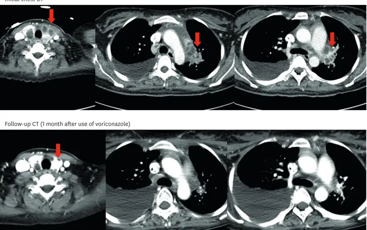 Fig. 1. Computed tomography (CT) images. (A) Initial chest CT shows multiple cystic lesions in both lobes of the thyroid gland (red arrows) and necrotic  lymphadenopathy in the para-aortic, right lower paratracheal, and left hilar lymph nodes (red arrows)