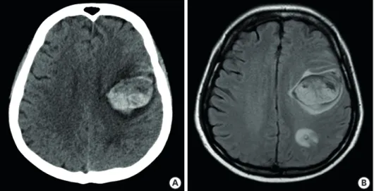 Fig. 3. Brain imaging. (A) Non-enhanced brain computed tomography scan, and (B) axial T2 FLAIR magnetic  resonance image shows multifocal hemorrhagic lesions with surrounding edema in the left frontal and parietal  lobe
