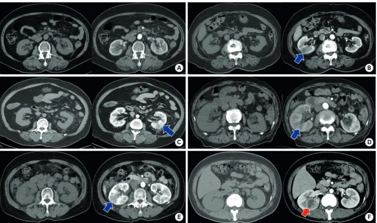Fig. 2. Grade of parenchymal involvement. (A) grade 0: no renal parenchyma involvement, (B) grade 1: less than 25% involvement, (C) grade 2: 25%–50% involvement,  (D) grade 3: 50%–75% involvement, (E) grade 4: greater than 75% involvement, and (F) Abcess