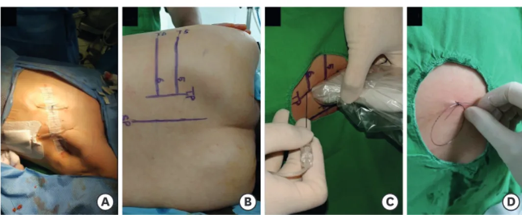 Fig. 1. Surgical incision and technique of the ESPB. Total mastectomy with sentinel lymph node dissection was  performed (A)