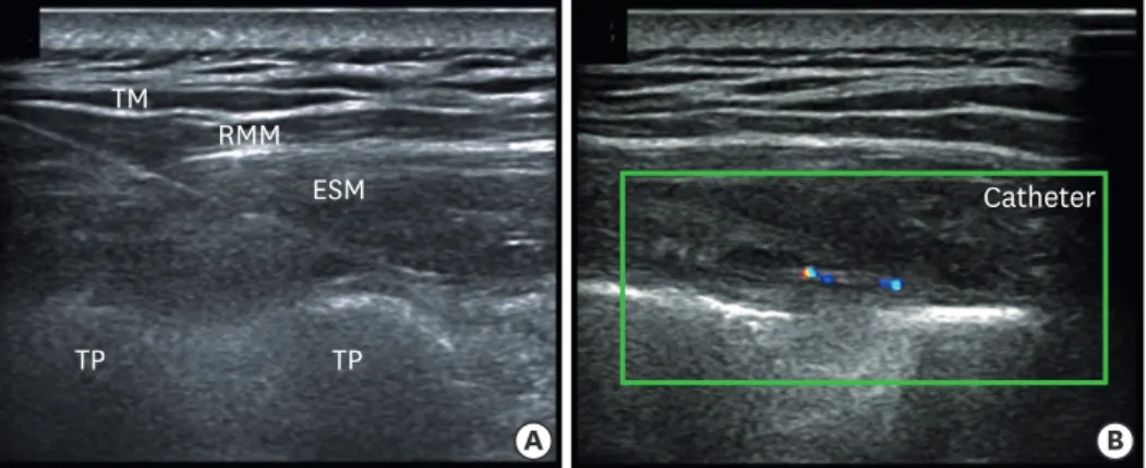 Fig. 2. Ultrasound-guided ESPB. A tuohy needle was inserted to contact the TP (A). After confirming proper  position of the needle, a 19-G epidural catheter was inserted above 2 cm via real-time US guidance (B)