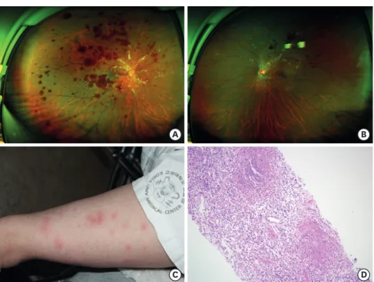 Fig. 1. Clinical features. (A) Wide-field fundus photography showed multiple retinal hemorrhages and severe  vascular sheaths around the optic disc in the right eye