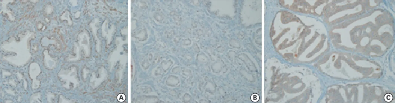 Fig. 4. The IH staining pattern of CDC6 differs between BPH and PCa tissues (200× magnification)