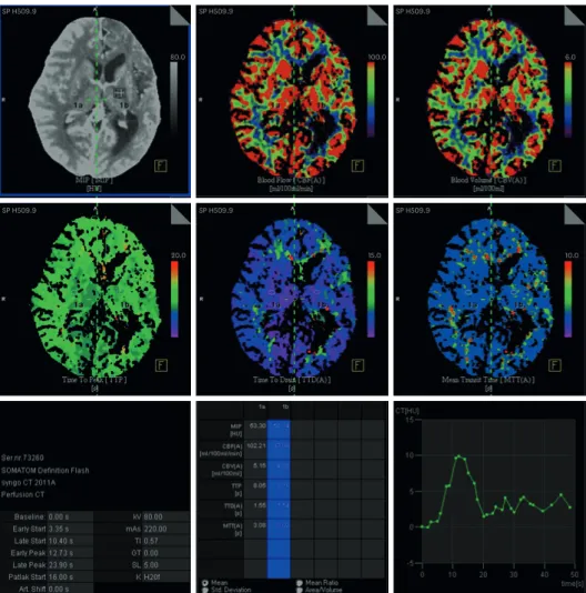 Fig. 2. Brain perfusion scan showed no significant difference of cerebral blood flow (102.21 vs