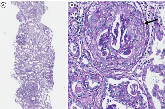 Fig. 2. Photomicrograph of the kidney biopsy. (A) Crescent formation is observed in 39% of the total 41 glomeruli  by the light microscopy (PAS, ×40)