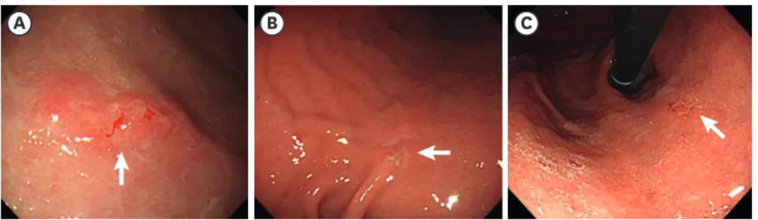 Fig. 1. Images of upper endoscopy for early gastric cancers. (A) Elevated and reddish lesion sized 1.5 cm with  spontaneous bleeding (arrow) is found on the antrum greater curvature