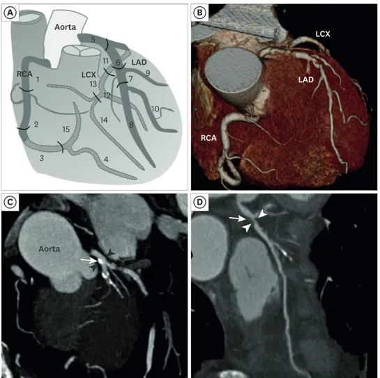 Fig. 1. The anatomy of the coronary arteries and the representative CCTA images of coronary artery disease