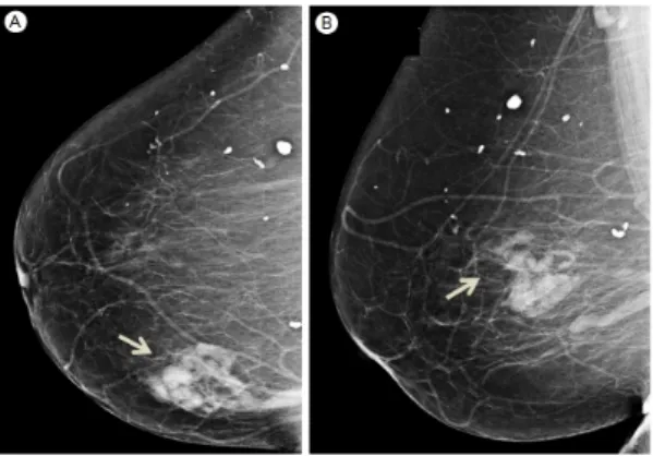 Fig. 1. Mammography before three years.