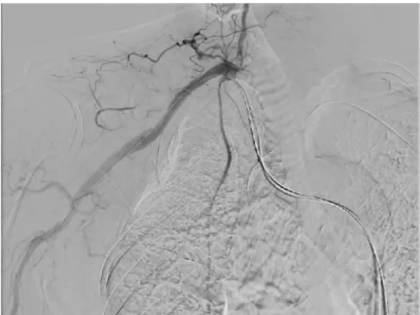 Fig. 4. Completion of angiography showed complete exclusion of the lesion and normal flow through the subclavian artery and its branches.