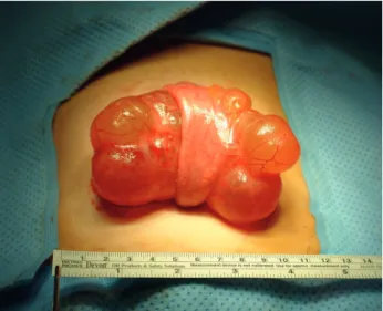 Fig. 3. Photograph of the 9 cm sized round cystic mass removed from patient No. 7. The mass originated from the  jejunal mesentery and stretched the adjoining jejunum.