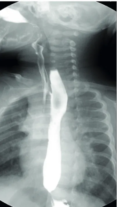 Fig. 3. Another H-type fistula at T2 level.