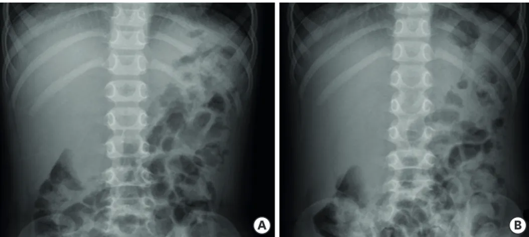 Fig. 1. Abdominal radiograph supine view (A) and erect view (B) indicated modest shadowing of gallbladder distension.