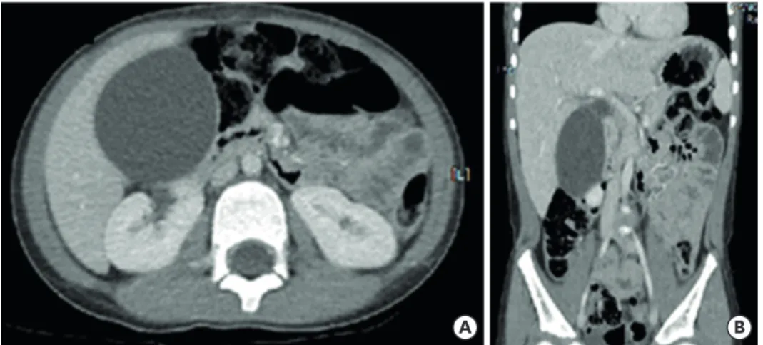 Fig. 4. Abdominal computed tomography (A, B) performed at 10 days after fever onset showed marked distended  gallbladder (8.0×5.5 cm in size) without wall thickening or sludge, which is consistent with gallbladder hydrops.