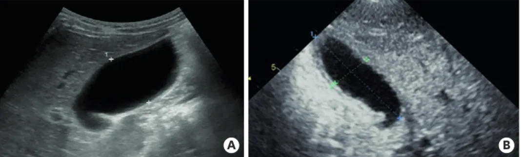 Fig. 5. Abdominal ultrasonography (A) performed at 23 days after fever onset revealed a slow regression of the  gallbladder hydrops (6.7×3.2 cm in size)