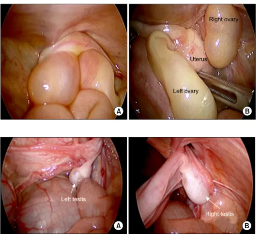 Fig. 2.  Herniation of both ovaries into  unilateral  inguinal  canal.  (A)  Before  reduction