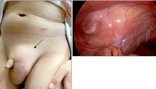 Fig. 4.  Retroperitoneal lymphangioma  which  was  misdiagnosed  as  inguinal  hernia (arrow)
