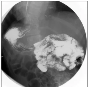 Fig. 2.  Diffuse gaseous distension of colon on abdominal X-ray.
