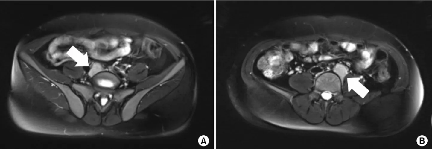 Fig. 2.  Technetium-99m RBC scintigraphy shows uptake in both common iliac area masses
