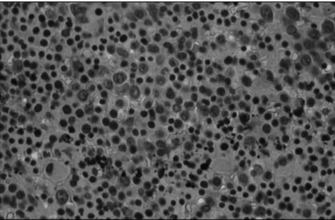 Fig. 3.  The photomicrograph shows many polymorphous myeloid cells (H&amp;E, ×400). 분지부에 위치하고 있었고, 주변 조직으로 침윤은 심하지 않 아 혈관을 조심하면서 박리하여 절제하였다