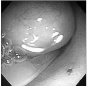 Fig. 4.  Histopathologic finding of the duplication cyst demonstrating  gastric mucosa (H&amp;E, ×100).