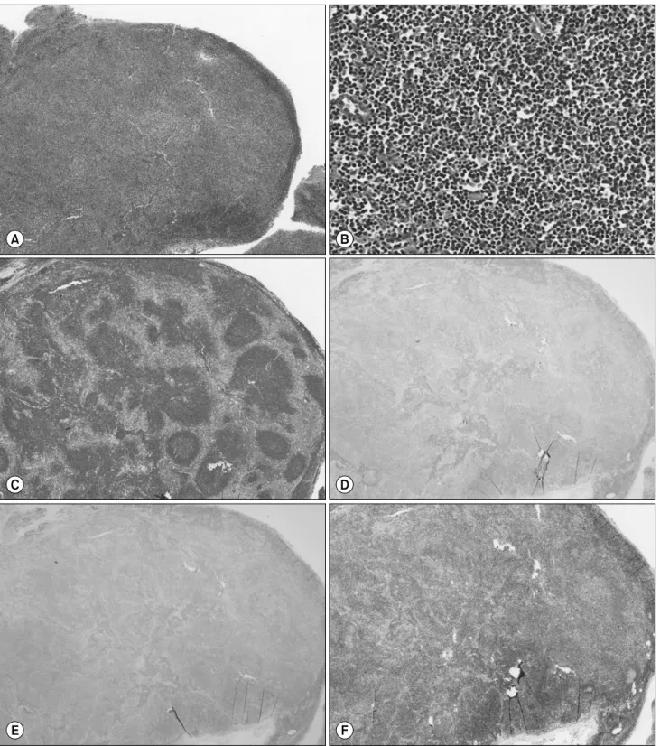 Fig. 3.  Immunophenotypic features of excised mass. (A) H&amp;E stain (×40) showing a gross lymphoid tissue with effaced normal follicular architectures  suggesting neoplastic rather than reactive condition
