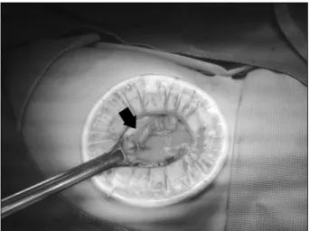 Fig. 4.  Exploratory laparotomy removal of about 5 cm sized Meckel  diverticulum.