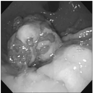 Fig. 1.  Endoscopic finding shows multi-lobulated polypoid mass with  oozing at upper body of stomach.